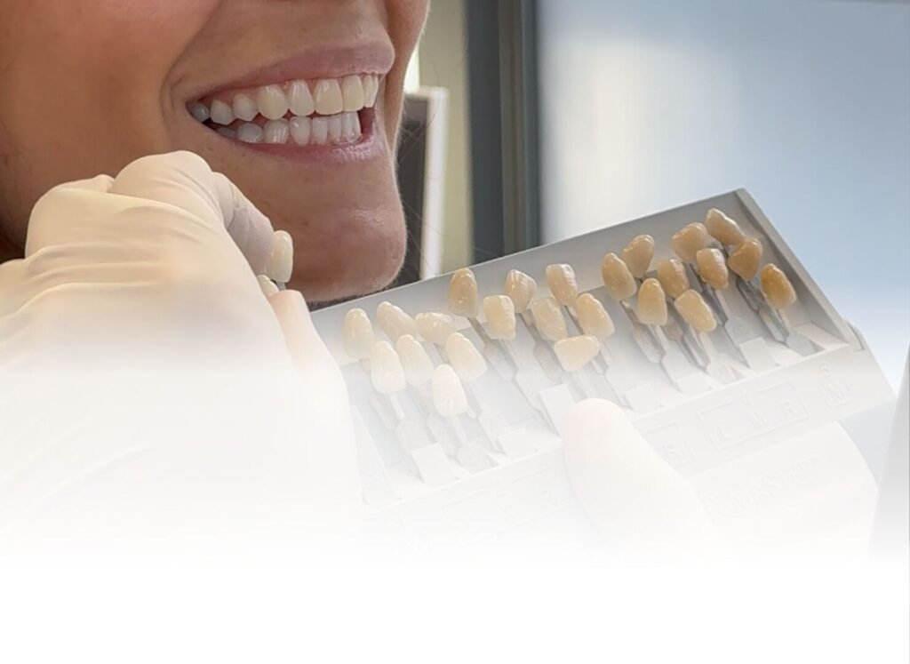 Le faccette dentali rovinano i denti