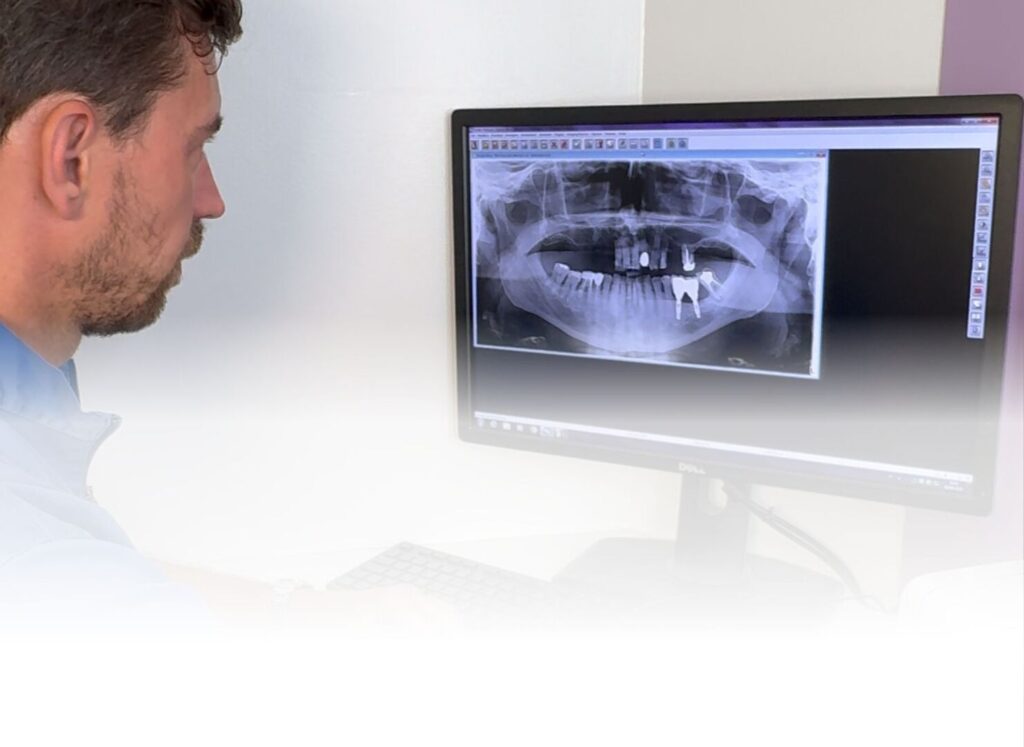 Infezione dopo un impianto dentale: sintomi da conoscere 2 Infezione dopo un impianto dentale