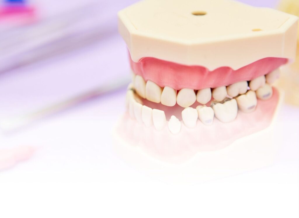 La malocclusione dentale: cos’è e come si cura 2 Malocclusione dentale